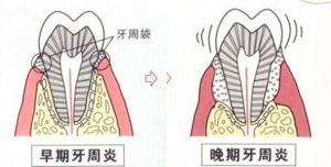 牙周袋