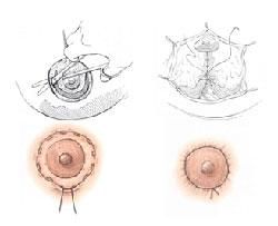 乳暈再造術