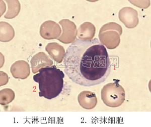 小兒結核性腦膜炎