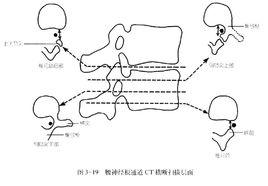 腰神經通道