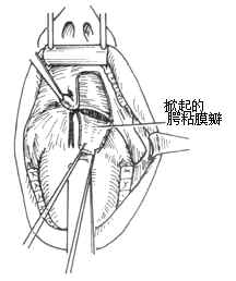 咽旁膿腫