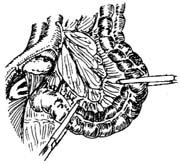 缺血性腸絞痛