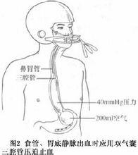 門脈高壓症