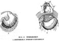 缺血性心肌病型冠心病的病理