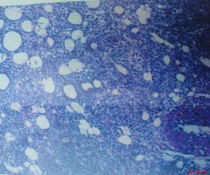 皮下脂膜炎性T細胞淋巴瘤
