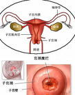 宮頸腺體囊腫