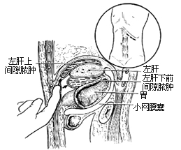 膈下膿腫