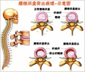 腰椎間盤突出症自我調理