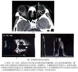 眼眶非霍奇金惡性淋巴瘤