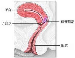 子宮頸殘端癌