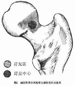 急性減壓性骨壞死