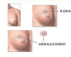 乳腺惡性腫瘤