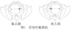 持續性枕橫位難產