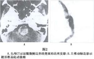 （圖）腦內動脈瘤