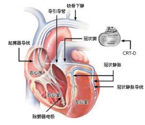 ICD植入技術