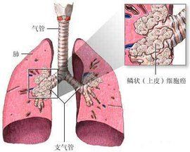 鱗形細胞癌