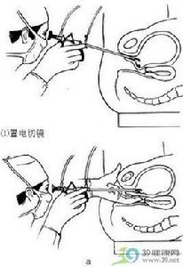 經尿道膀胱腫瘤電灼術