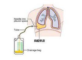 滲出性胸水