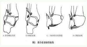 脛腓下聯合前部分離病因