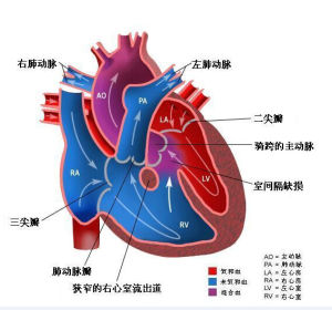 心臟雜音