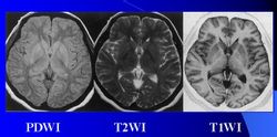 頭部質子密度成像，T1、T2像