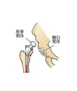 髖關節置換