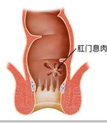 肛門息肉