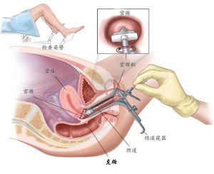 宮頸鱗狀細胞癌的治療