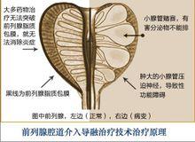 腔道介入導融技術