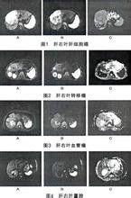 磁共振彌散加權成像