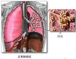 喘息性肺炎