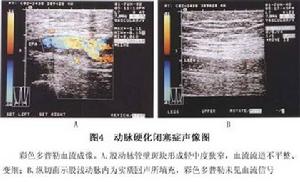 下肢動脈硬化閉塞症