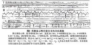 左前分支傳導阻滯