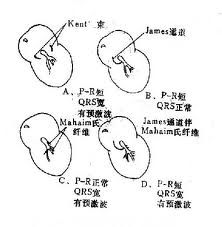 預激症候群