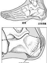 跟腱後滑囊炎