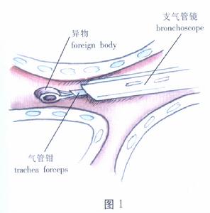 氣管、支氣管異物