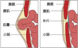 腹壁疾病