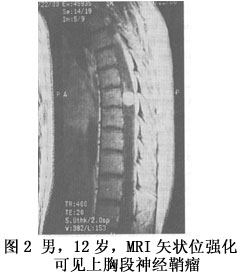 小兒椎管內腫瘤