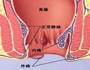 環狀混合痔