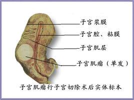 肌壁間子宮肌瘤