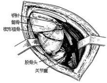 示意圖5:植入楔形骨塊並用鋼針內固定