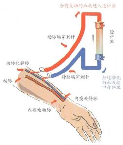 動靜脈瘺