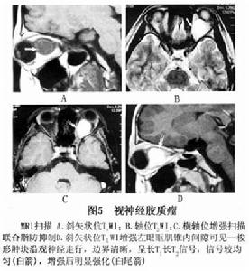 視神經膠質瘤