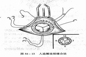 急性縱隔炎