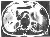 急性感染中毒性腦病