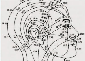 低頻脈衝電針治療技術，疏通經絡，改進氣血循環