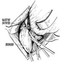 圖8:做膀胱壁瓣(示意圖)