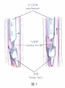氣管、支氣管異物