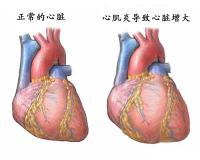 致心律失常型右室心肌病