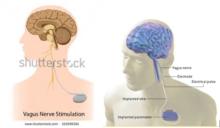 迷走神經刺激器